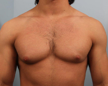 Gynecomastia Surgery